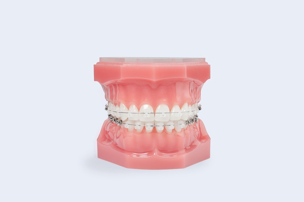 Comfort Cover Dental Braces Shield